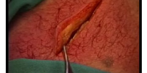 Différentes méthodes pour suturer une plaie