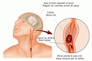 Détecter un Accident vasculaire cérébral AVC