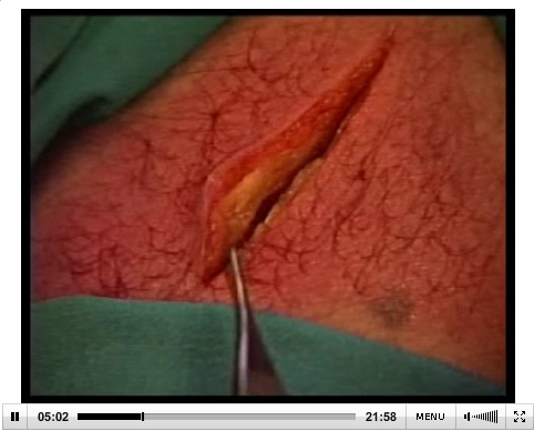 Différentes méthodes pour suturer une plaie